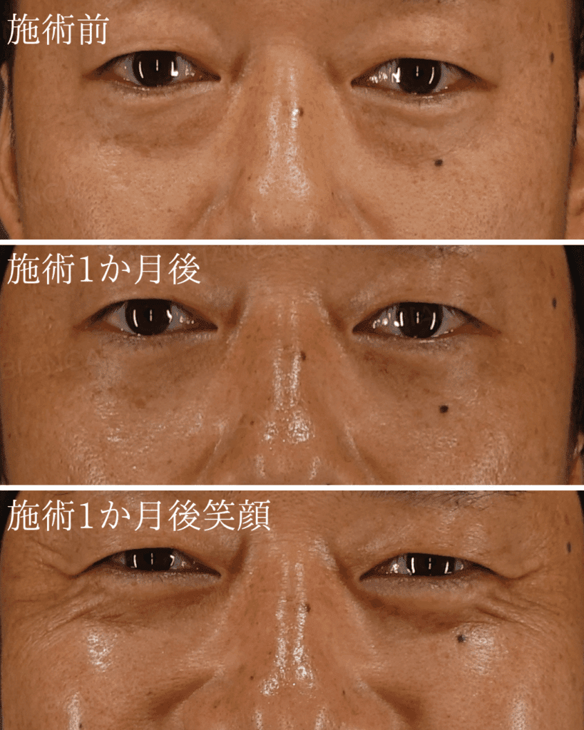 脱脂のダウンタイムはどれくらい？経過と過ごし方解説　(ダウンタイム写真あり)