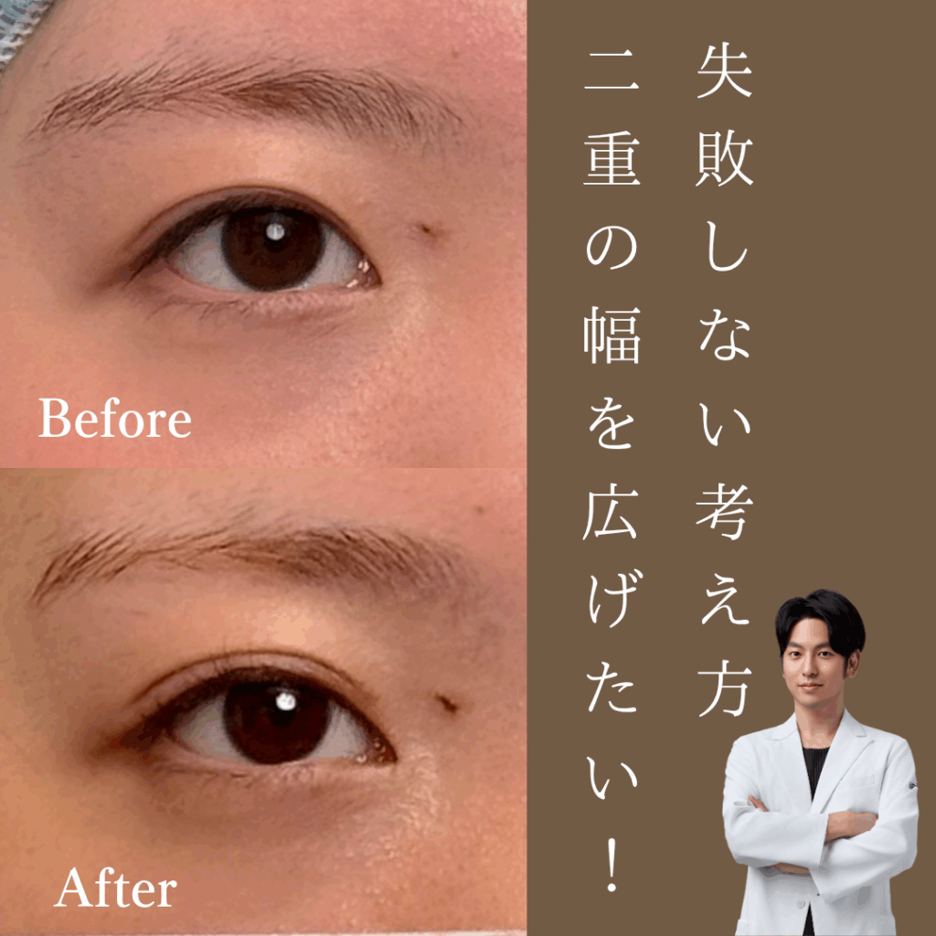 二重の幅を広げたい！失敗しないために二重整形の考え方を学ぼう