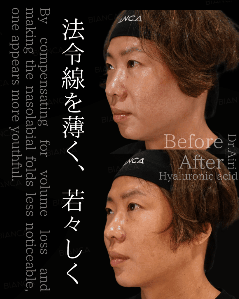 法令線ヒアルで若々しい印象に！効果や持続期間・ダウンタイムを徹底解説
