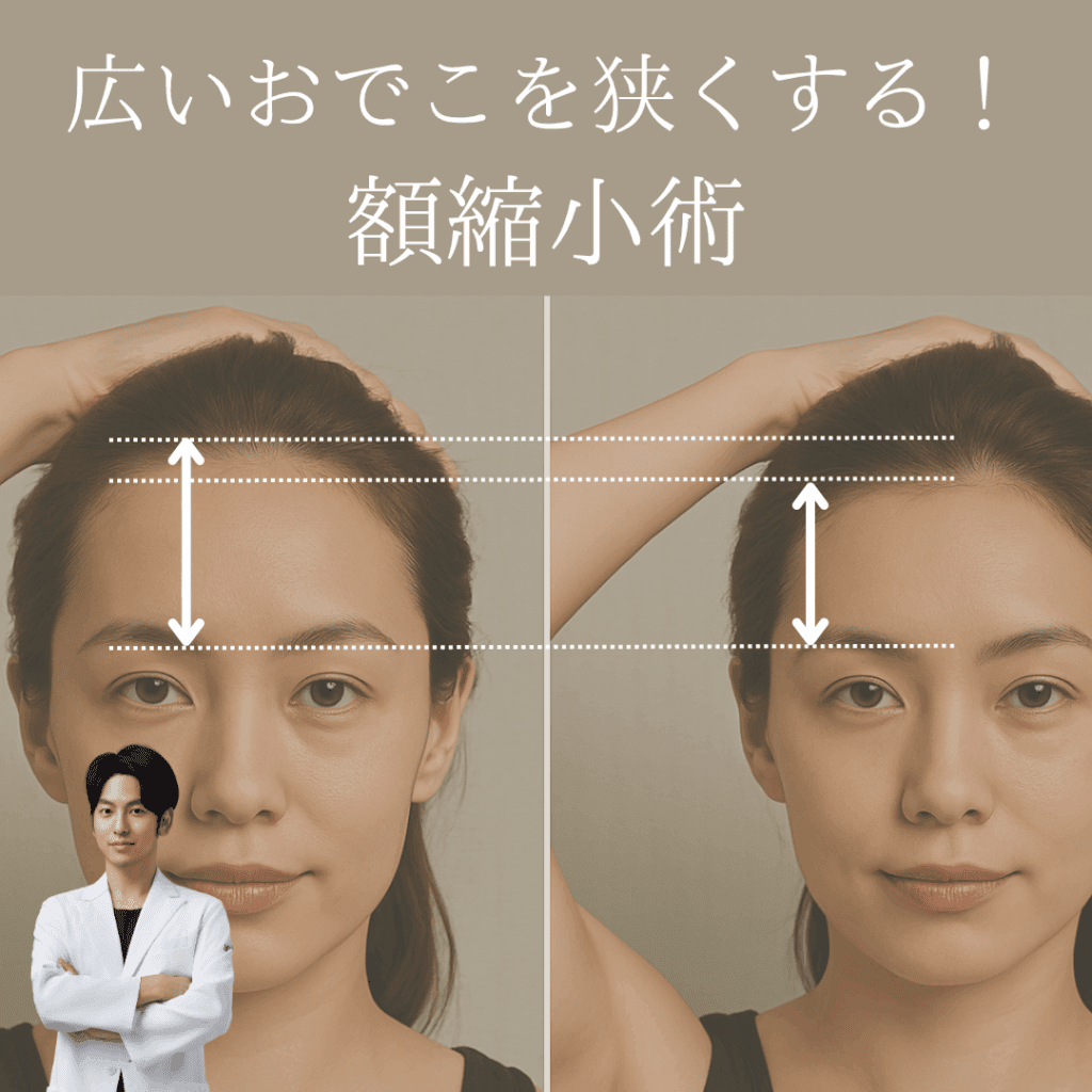 広いおでこを狭くする！額縮小術とは