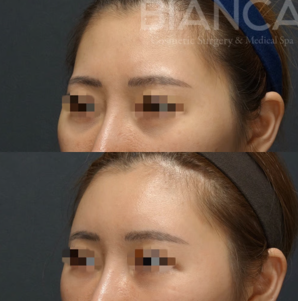 脂肪注入による若返り・自然にボリュームUP【基本編】