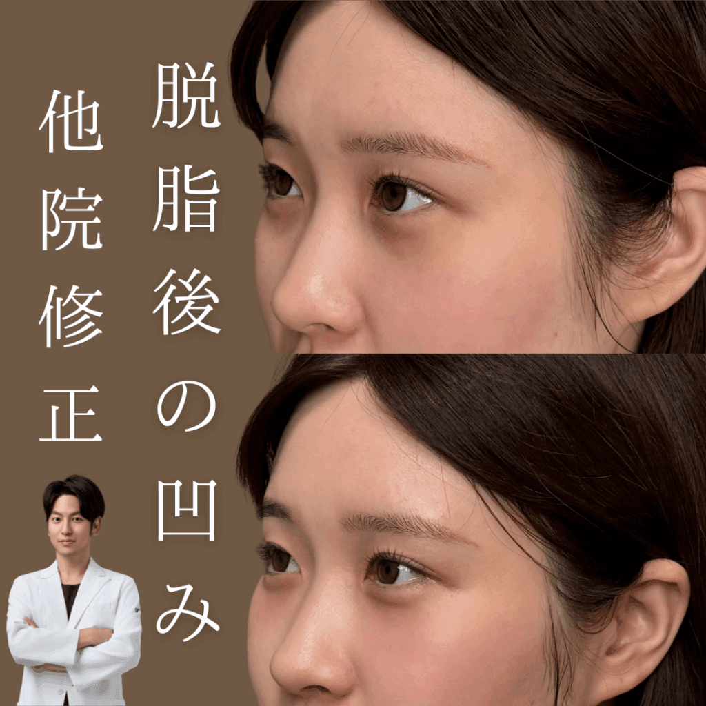 脱脂後の凹み、治します！