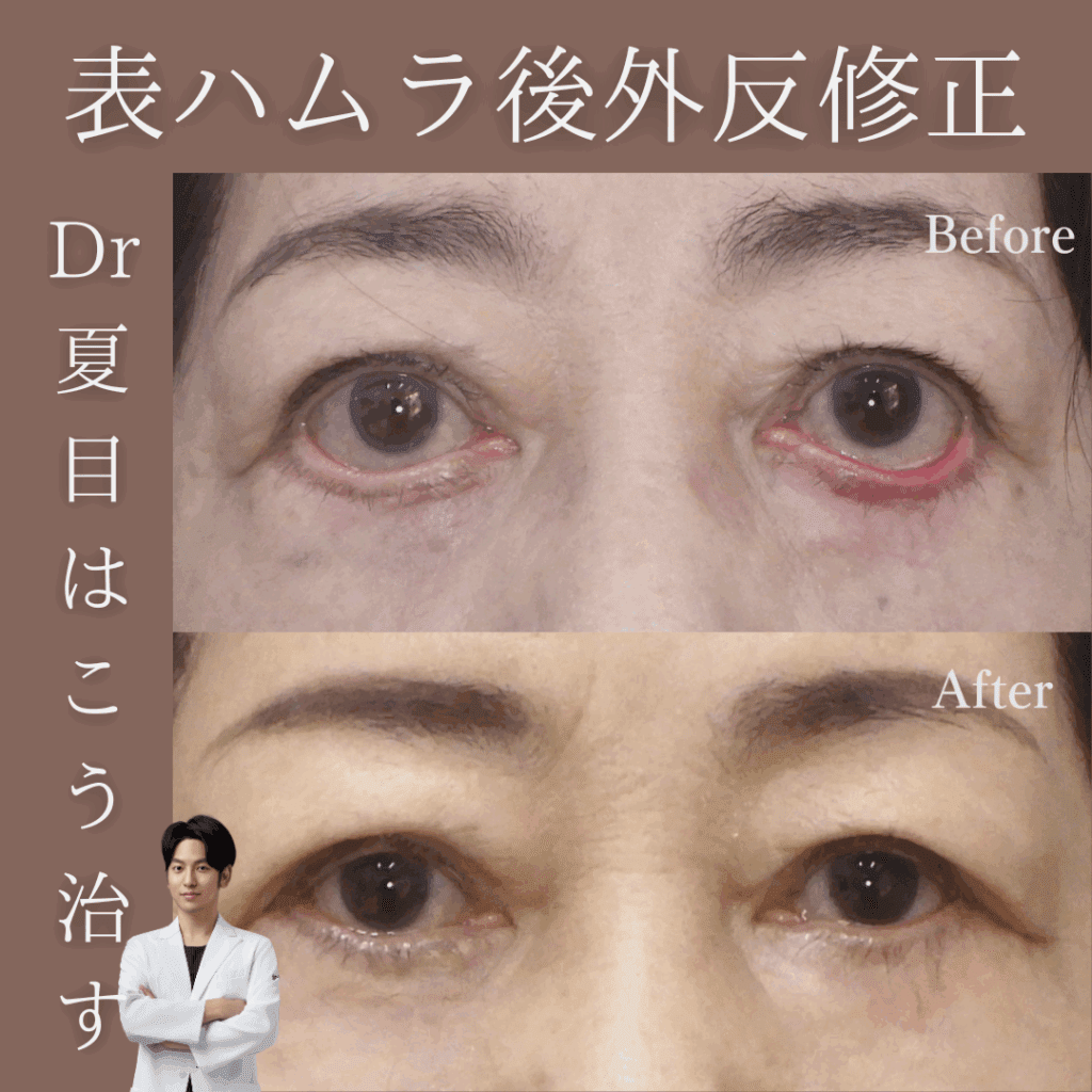 表ハムラ後外反…他院修正