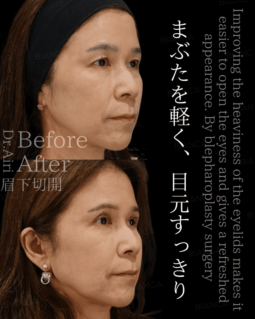 眉下切開Part2：よくある質問をQ&A形式で答えます