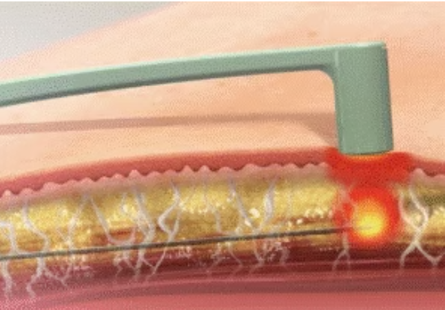 エンブレイスRFでフェイスラインのタイトニング