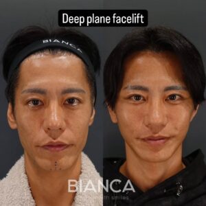 ディーププレーンフェイスリフト 男性のフェイスラインを引き締めるには？たるみの原因と改善アプローチを医師が解説【ビアンカクリニック】