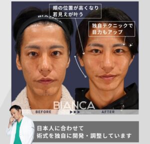 ディーププレーンフェイスリフト