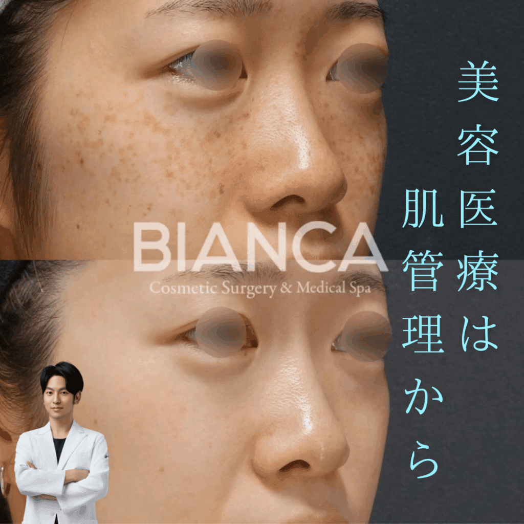 ピコトーニング、ピコスポット、ピコフラクショナル違いは？