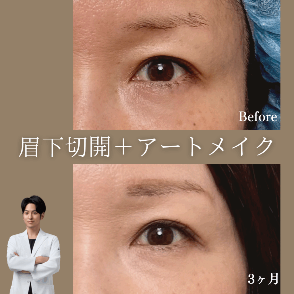 眉下切開は眉アートメイクの併用がおすすめ