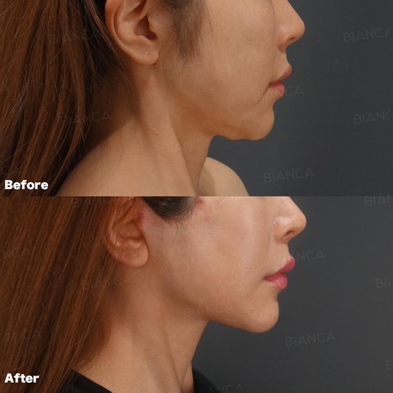 ディーププレーンフェイスリフト ビアンカ銀座｜日本を代表する美容健康再生医療のクリニック