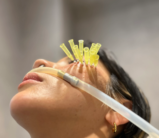 ショッピングリフトでたるみ、引き締め治療