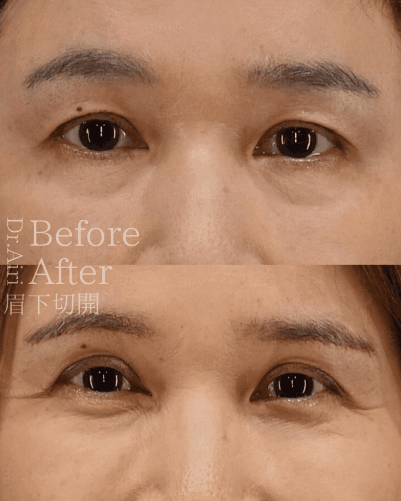 眉下切開とは？自然な若返りを目元から！効果・ダウンタイム・適応を解説