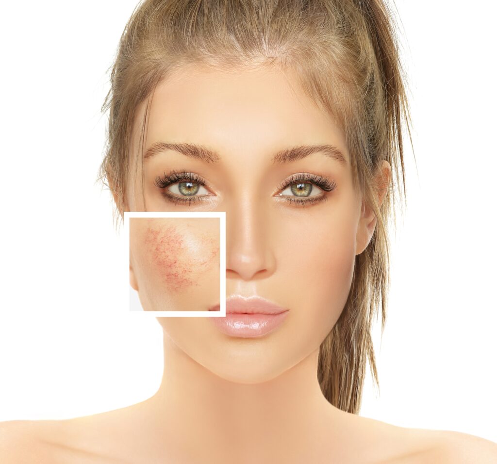 顔の赤みの治療どうする？