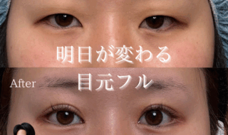 印象激変の目元フル整形｜ビアンカ銀座｜日本を代表する美容健康再生医療のクリニック