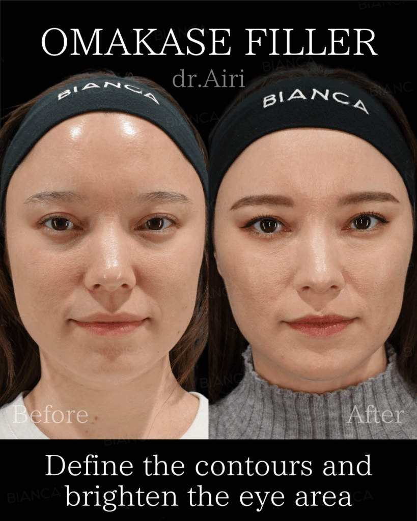 TFT(トータルフェイシャルトリートメント)ヒアルロン酸とは？木を見ず森を見る！顔全体を整える注入アプローチ