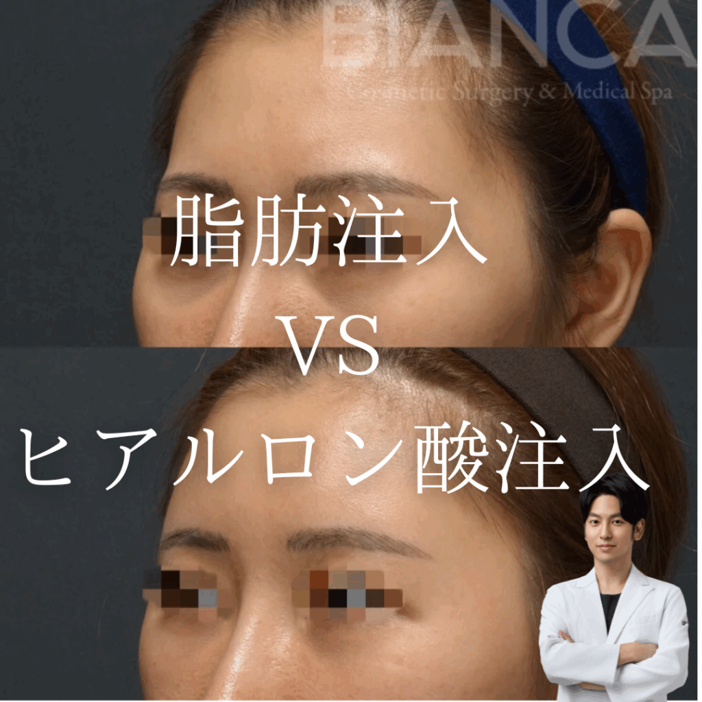 脂肪注入vsヒアルロン酸、顔のボリューム不足にはどちらがいいの？