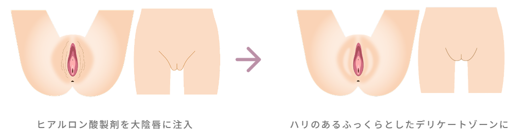 大陰唇ヒアルロン酸注射とは