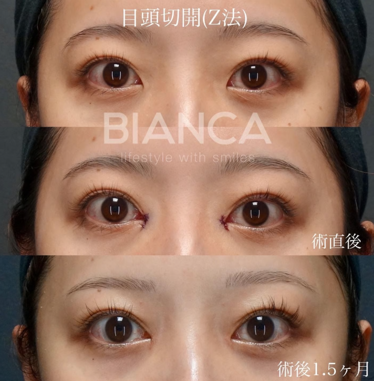 目頭切開で目元をより魅力的に！効果・ダウンタイム・適応を解説