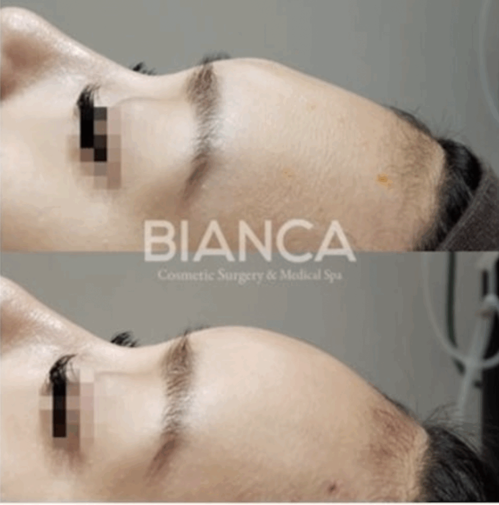 額ヒアルロン酸は何cc必要？おでこの形を丸くする方法