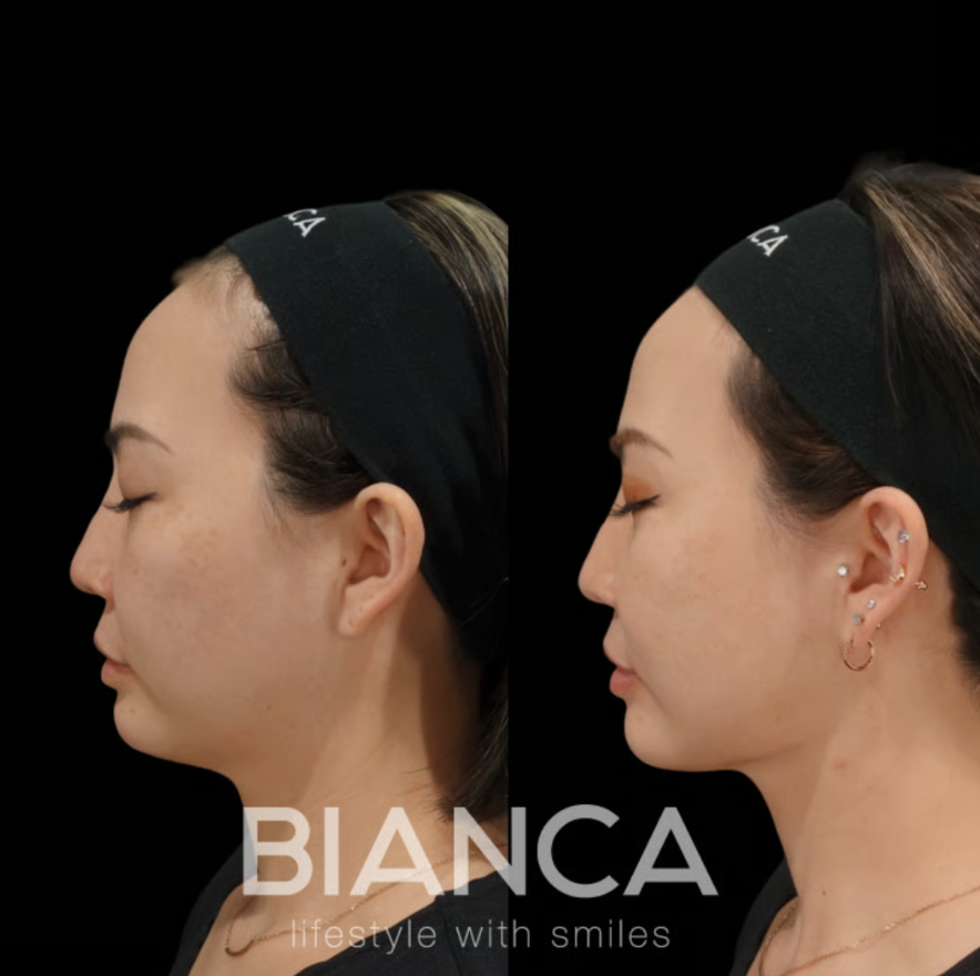 二重あご改善！最新顎下治療のススメ