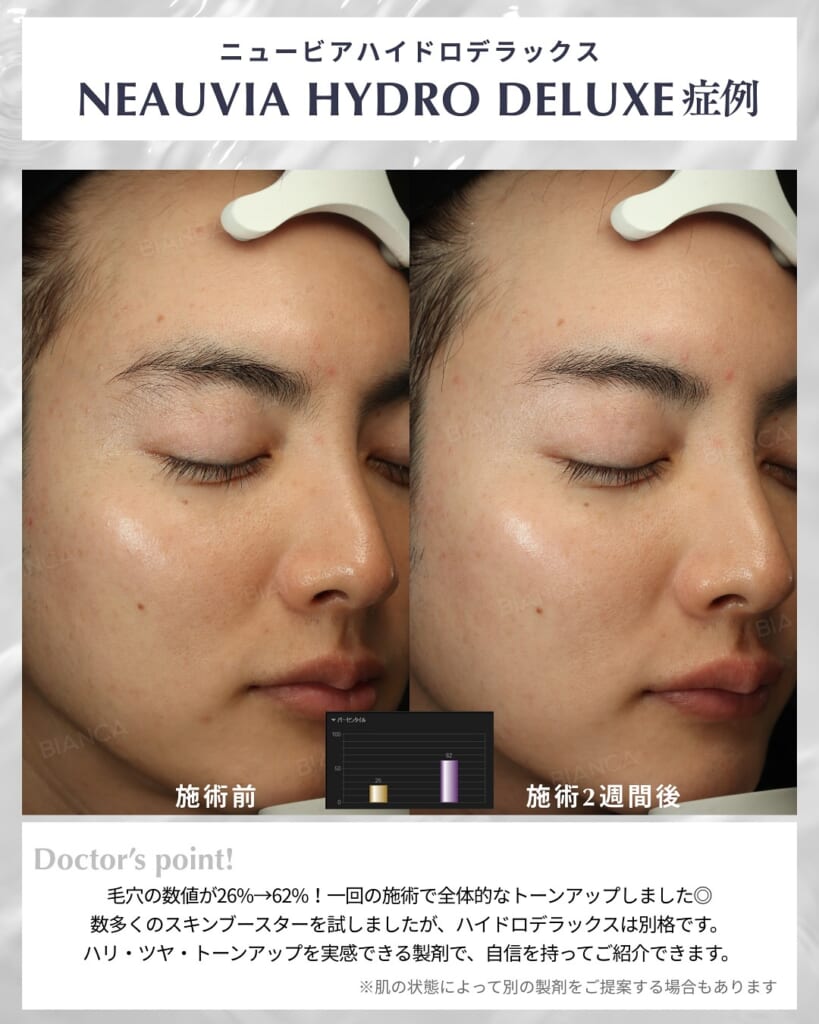 美容医療の世界で注目されているヒアルロン酸製剤 NEAUVIA の紹介します❣️