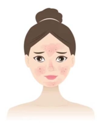 赤ら顔、実は酒さという疾患かもしれません