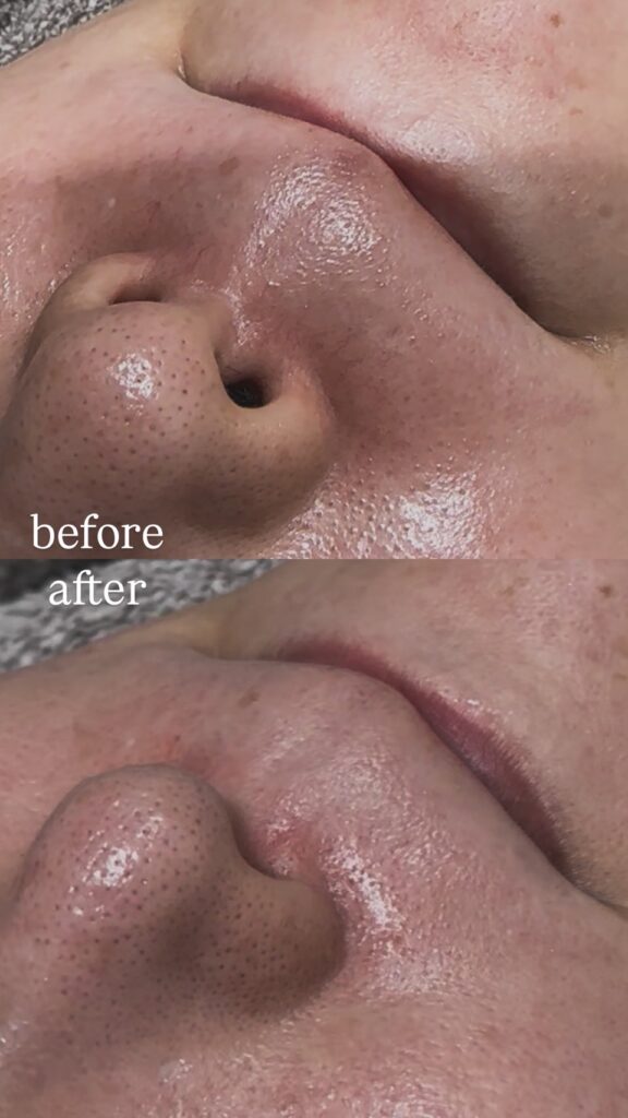 アドバテックスレーザーでにょろにょろ退治！ビアンカ式の治療法を紹介します