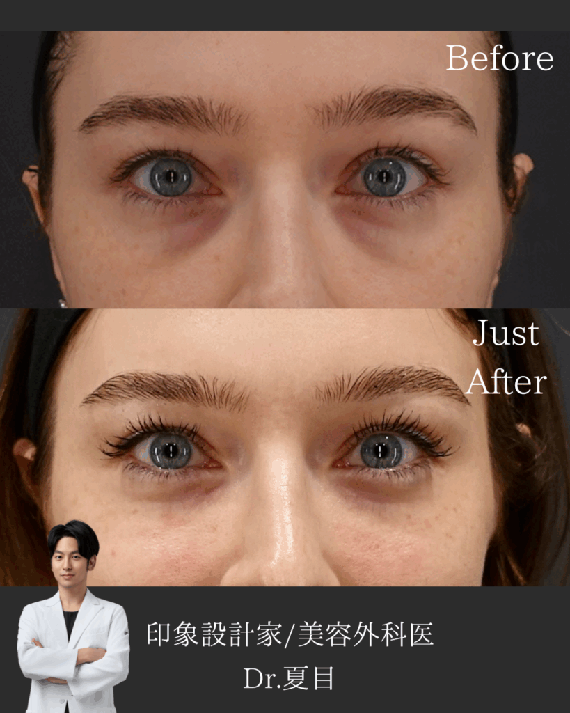 手術なしでクマを改善！ヒアルロン酸とベビーコラーゲンのコンビネーション治療