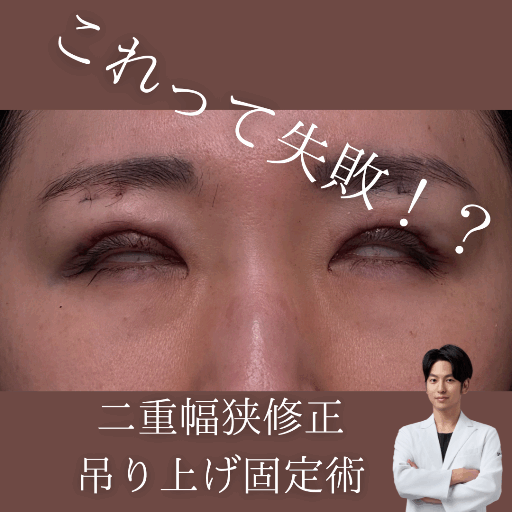 目が閉じない？二重幅狭修正、吊り上げ固定術