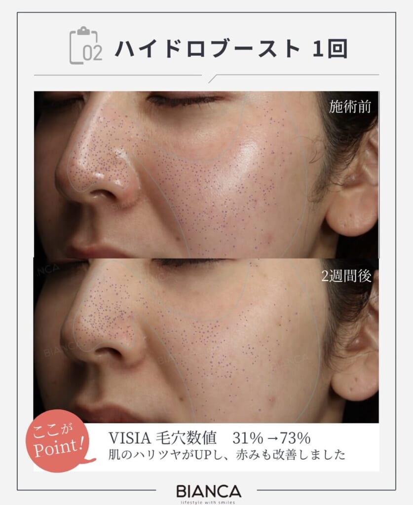 🌸【最新美肌治療】ハイドロブーストで肌を“再構築”🌸〜【Latest Skin Rejuvenation】Rebuild Your Skin with Hydro Boost〜