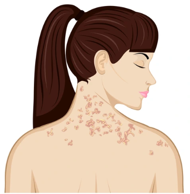 癜風がシミにみえることもあります