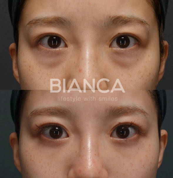 脂肪注入：よくある質問Q&A【Part3】