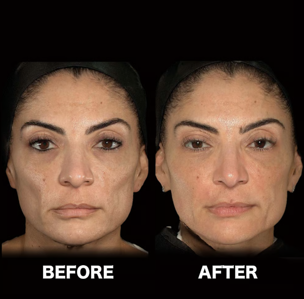 ハーモニカ（HArmonyCa）とは？話題のハイブリッドフィラーを深堀します