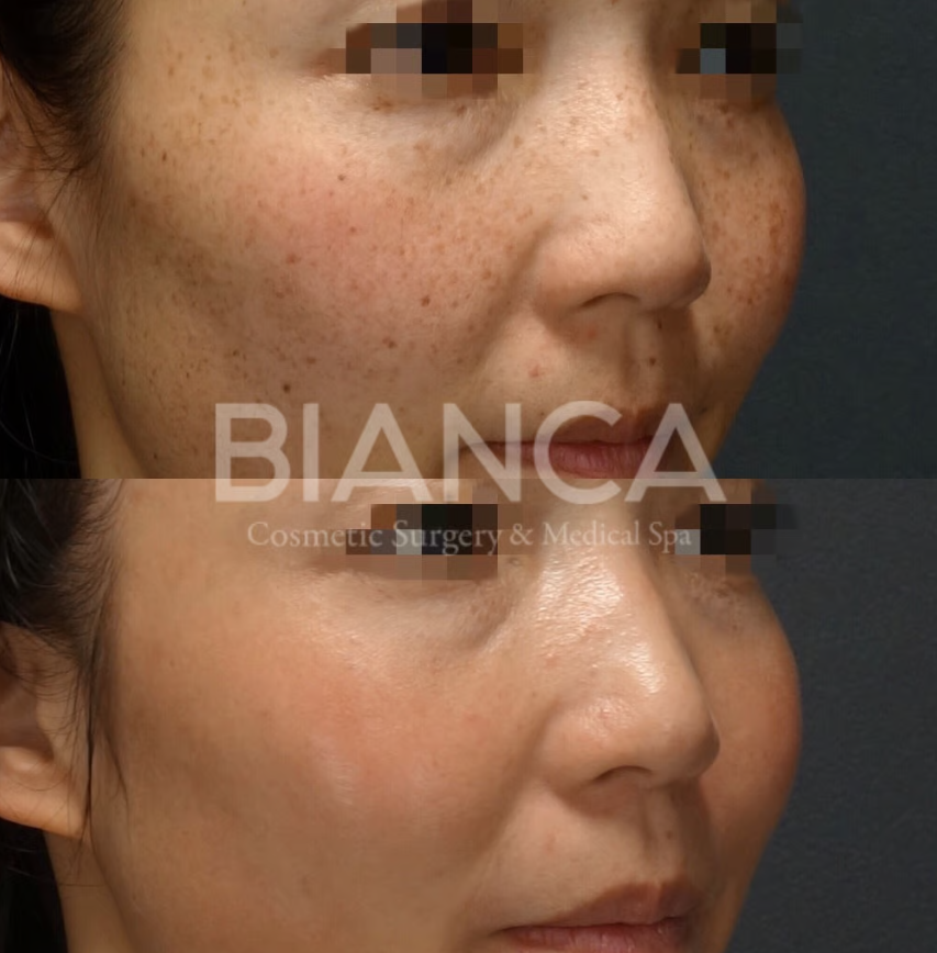 シミ取り季節到来！自分のシミにはどれがいい？各施術を比較説明します