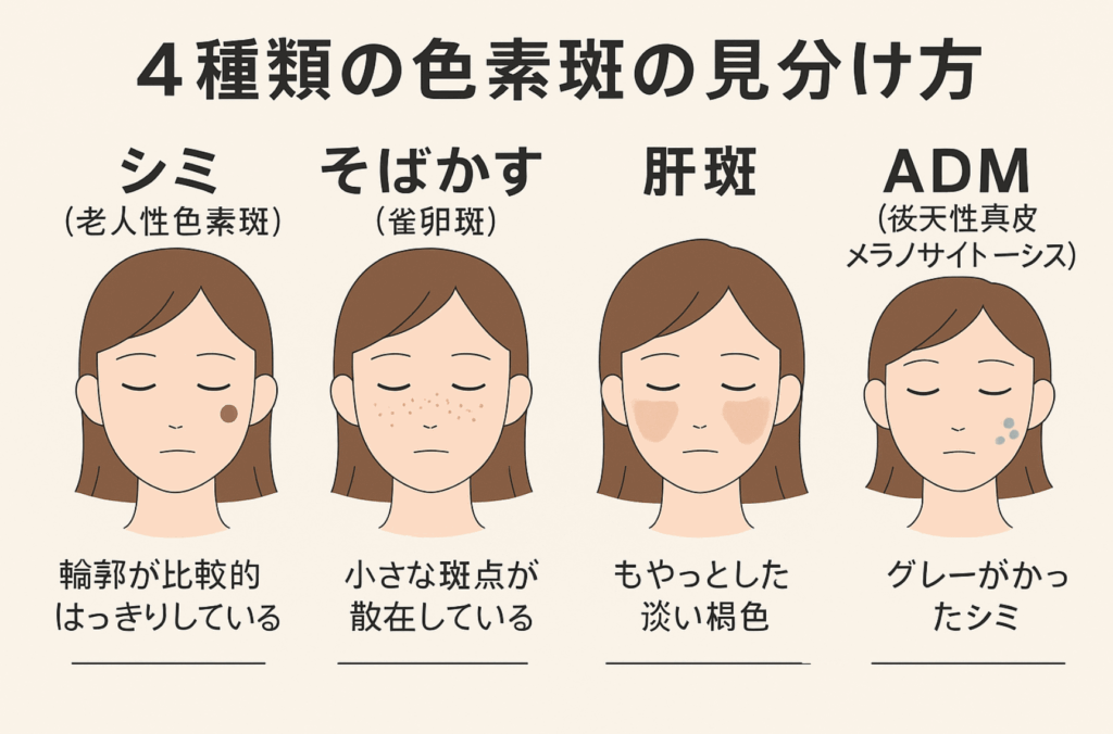 【美容皮膚科医が解説】シミ・そばかす・肝斑・ADMの違いとは？