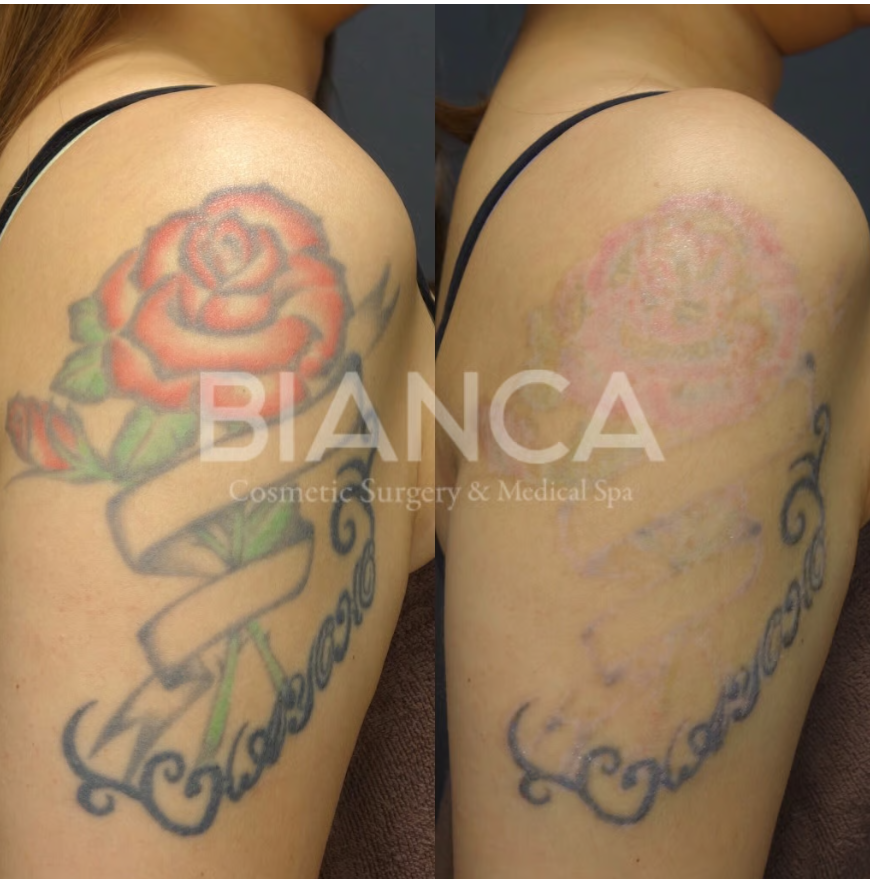 ピコスポットでタトゥーの除去はできる？色による波長の違い