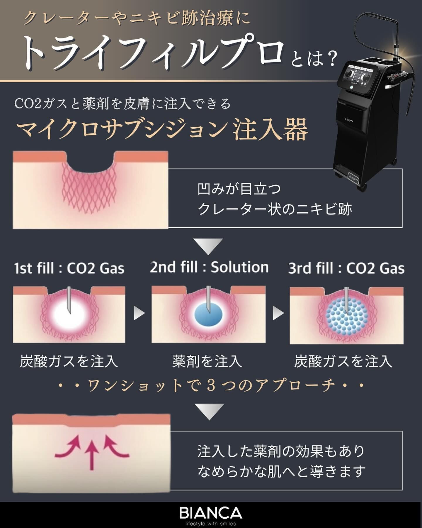 トライフィルプロの仕組みの解説図