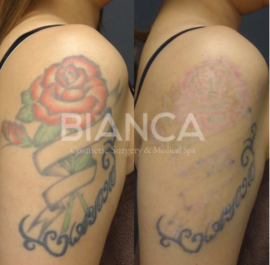 タトゥー消したいときはどうしたらいい？タトゥー除去の光と闇