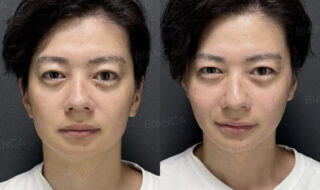 今年のたるみは今年の内に！BIANCAの糸リフト｜ビアンカ銀座｜日本を代表する美容健康再生医療のクリニック