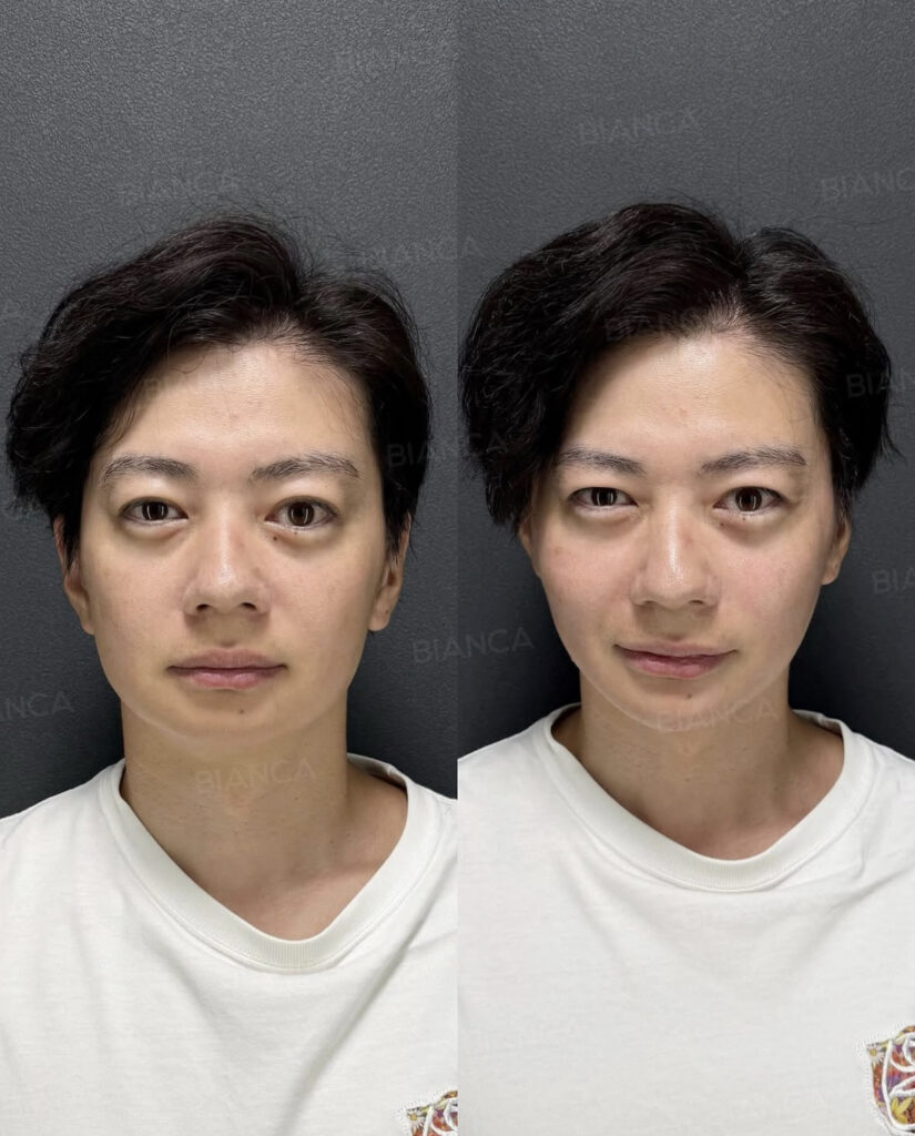 今年のたるみは今年の内に😌BIANCAの糸リフト✨