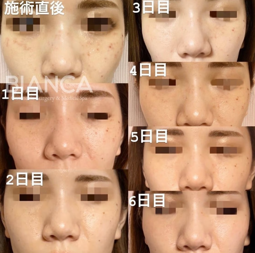 【医師監修】シミ取りのダウンタイムとは？期間・経過・注意点を徹底解説