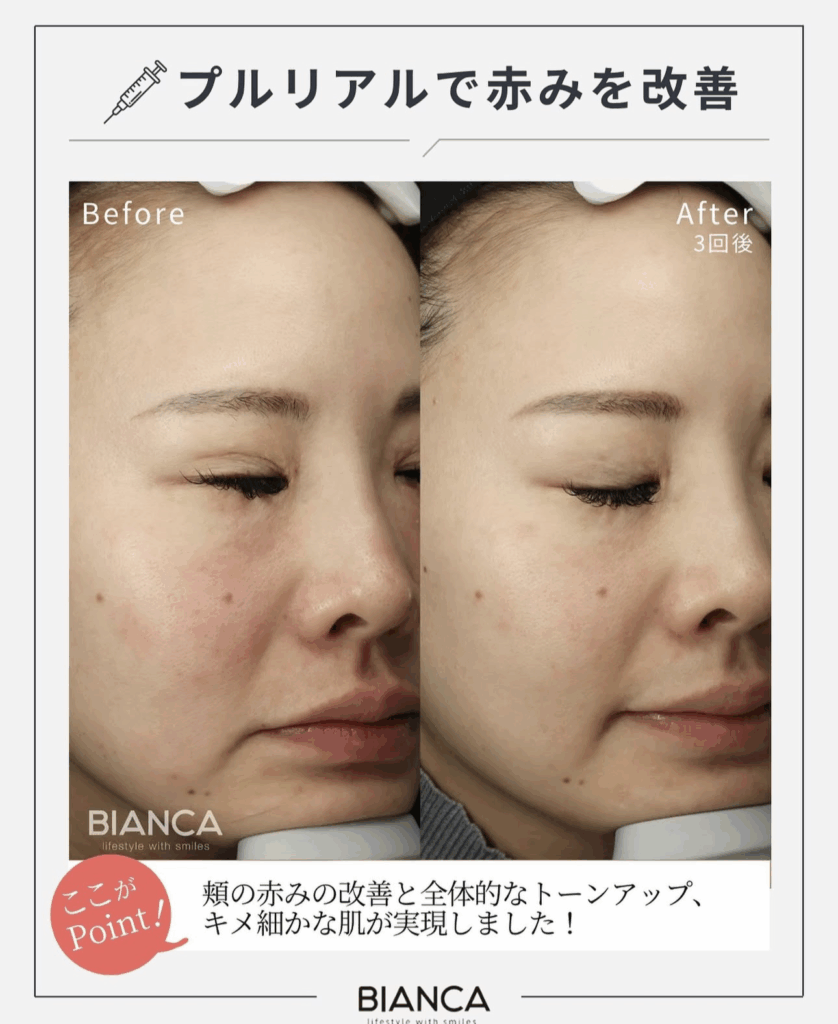 プルリアルデンシファイで叶える“肌再生注入”の秘密🙊