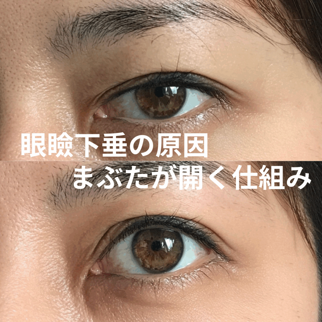 まぶたが開く仕組みと、眼瞼下垂の原因