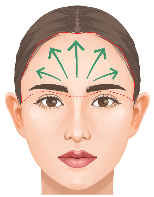 前額リフト　ビアンカ銀座｜日本を代表する美容健康再生医療のクリニック