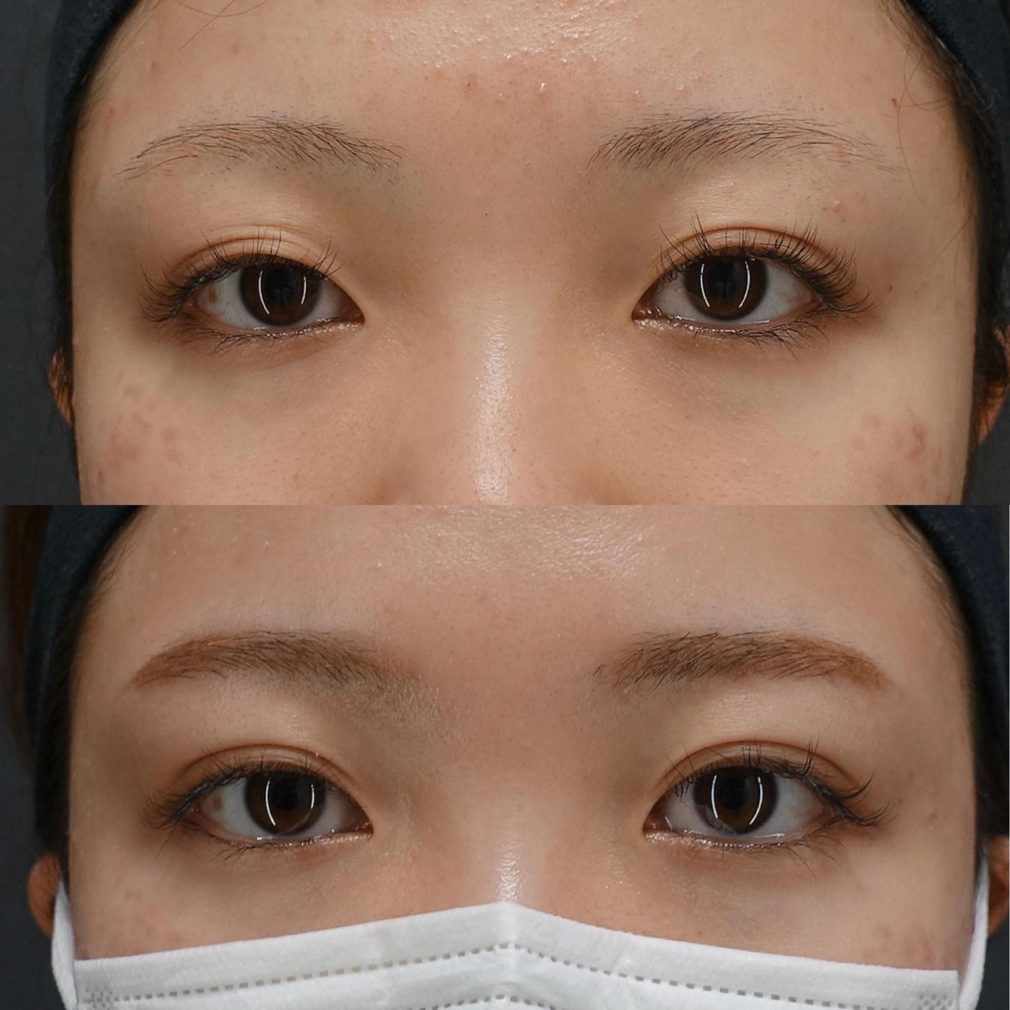 二重埋没法4点留め