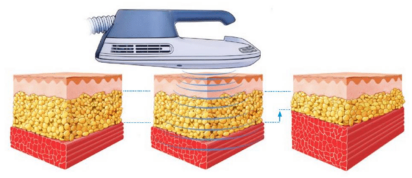 エムスカルプト（EMSCULPT） 銀座・表参道にあるBIANCA CLINIC ビアンカクリニック｜美容外科・美容皮膚科・再生医療・美容婦人科・美容内科・医療アートメイク