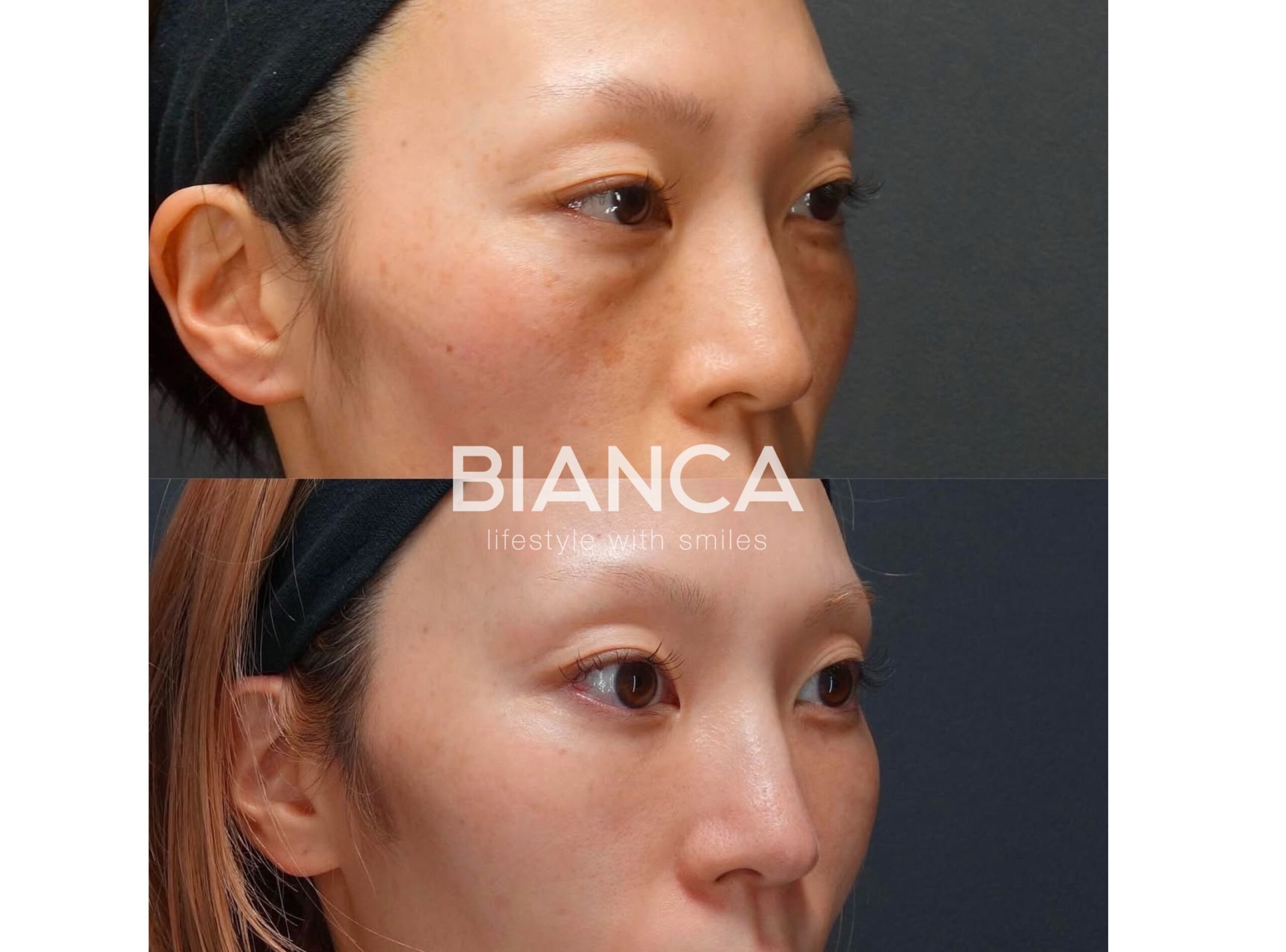 目の下のクマたるみ取り・コンデンスリッチフェイス（CRF）