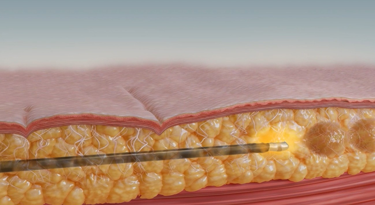 脂肪吸引との併用が可能