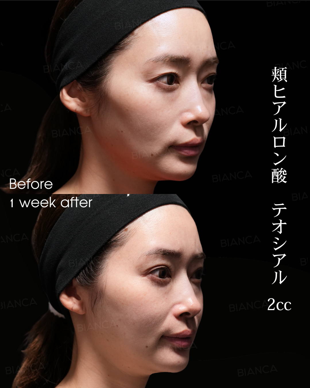 頬ヒアルロン酸注射
