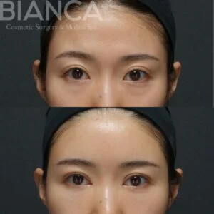 眼瞼下垂MT法・目頭切開・目の下クマたるみ取り・コンデンスリッチフェイス（額・コメカミ・目の下・ゴルゴライン）